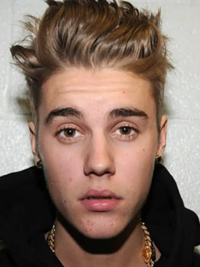 Justin bieber का आधा चेहरा paralysed हो गया है?